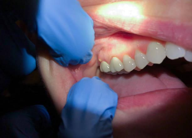 Best Urgent Care for Lost Fillings or Crowns in Mukilteo, WA