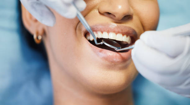Best Emergency Tooth Extraction in Mukilteo, WA